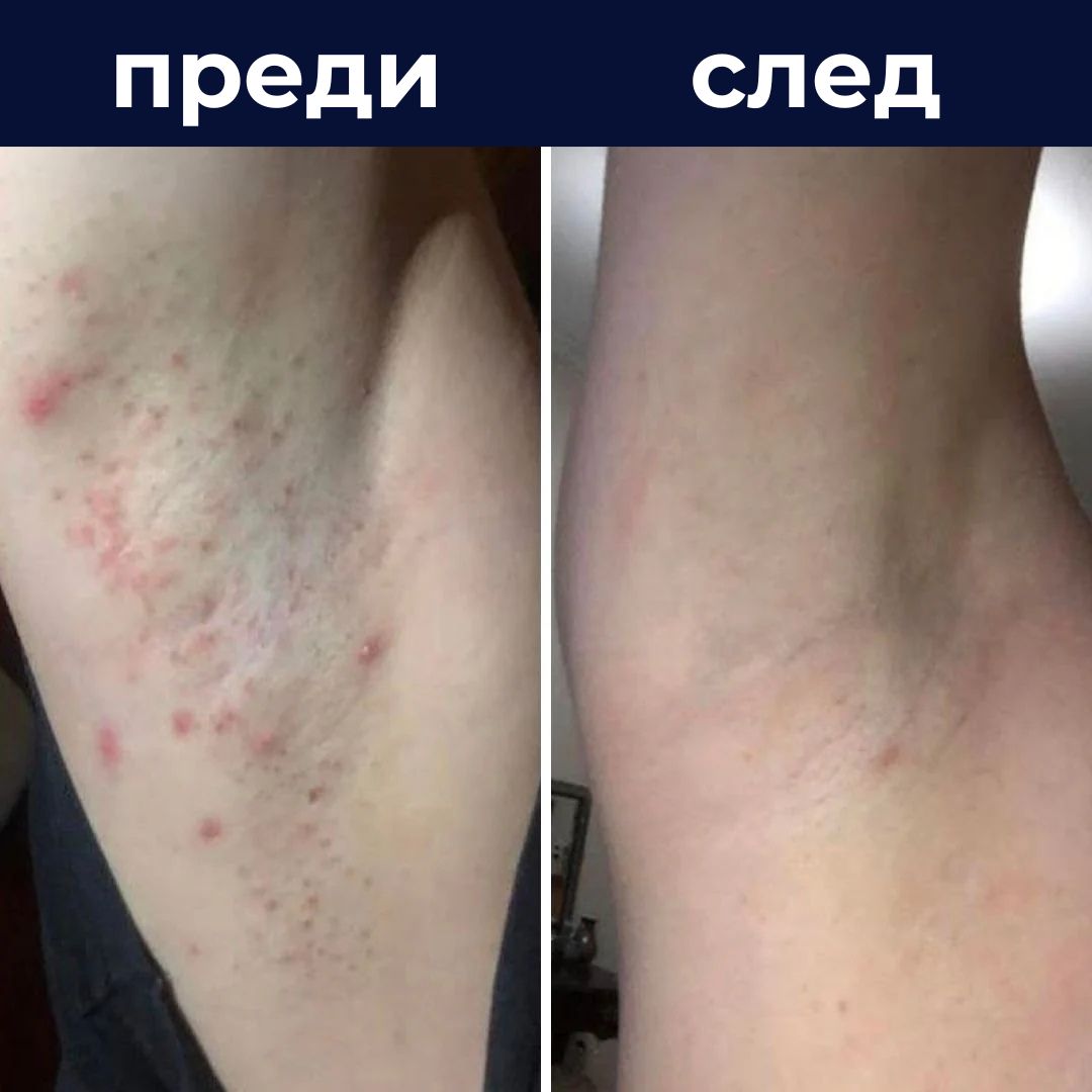 skinfleek™ метал самобръсначка