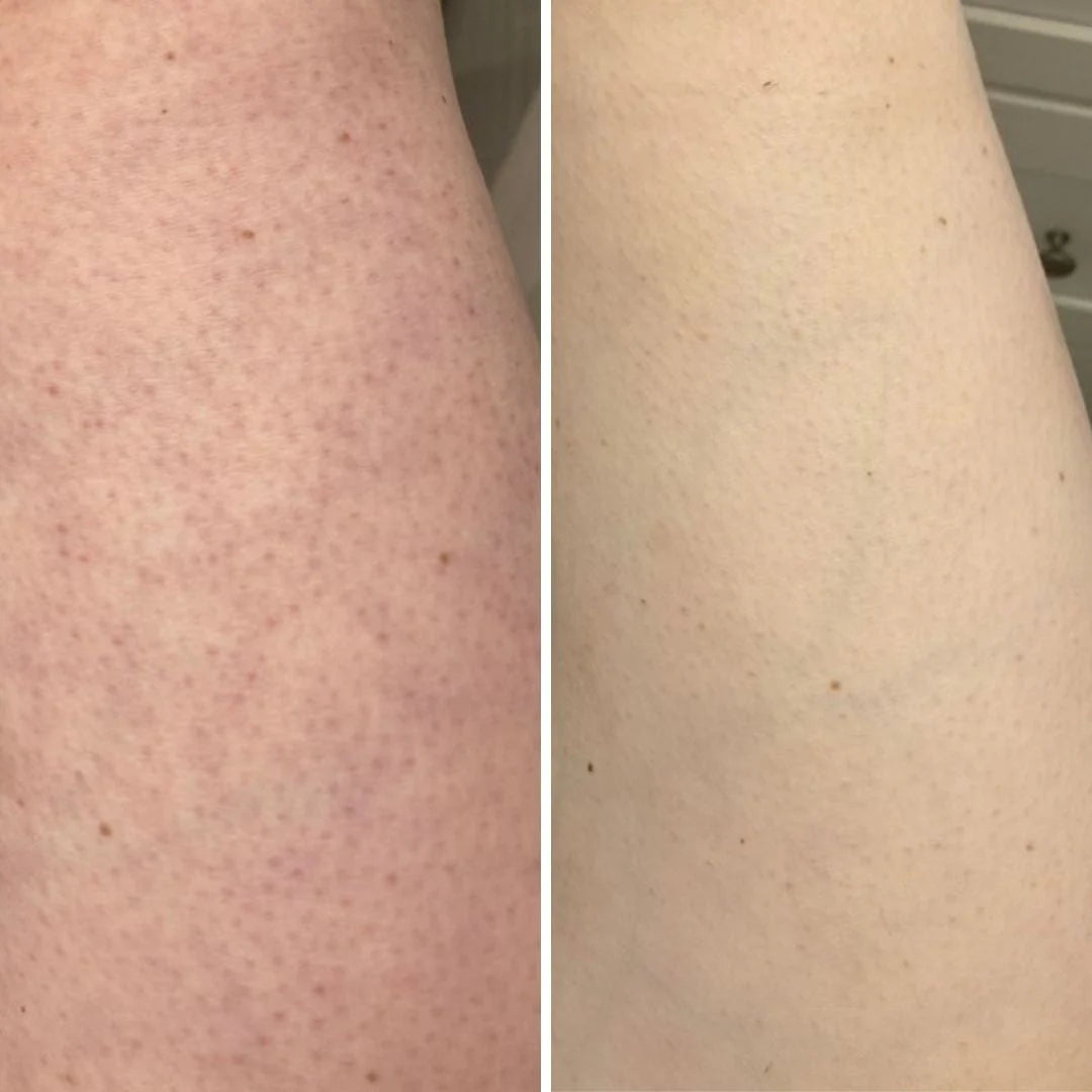 Before-After-Photo-Strawberry-Legs-KP_1080x1080_6a65ed08-baaf-45af-8964-4b2ab8bf3bd0_2048x2048.webp